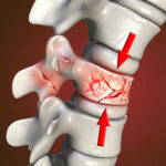 home-condition-compression-fracture